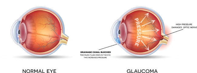 Glaucoma and normal eye