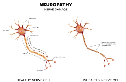 neuropathy nerve damage