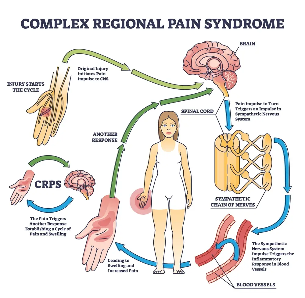 Understanding the Benefits of Marijuana for People with CRPS (Complex Regional Pain Syndrome Type II)